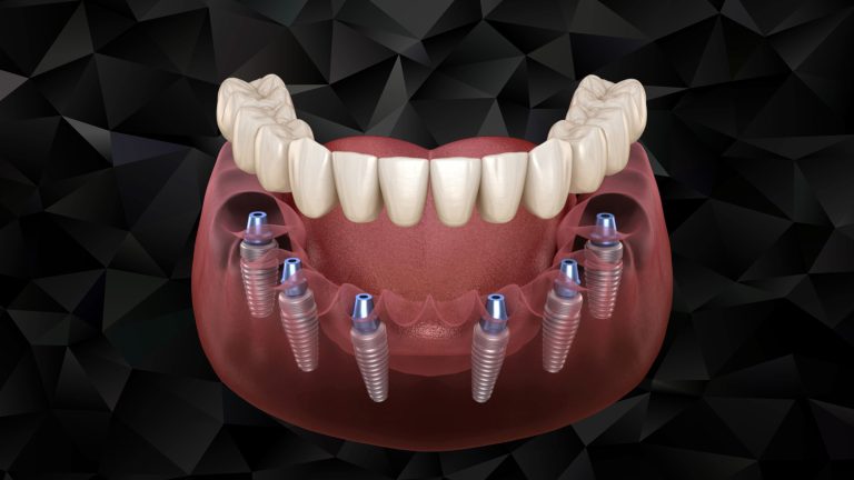 Implant all on 6 phục hình cho hàm bị mất răng hàng loạt