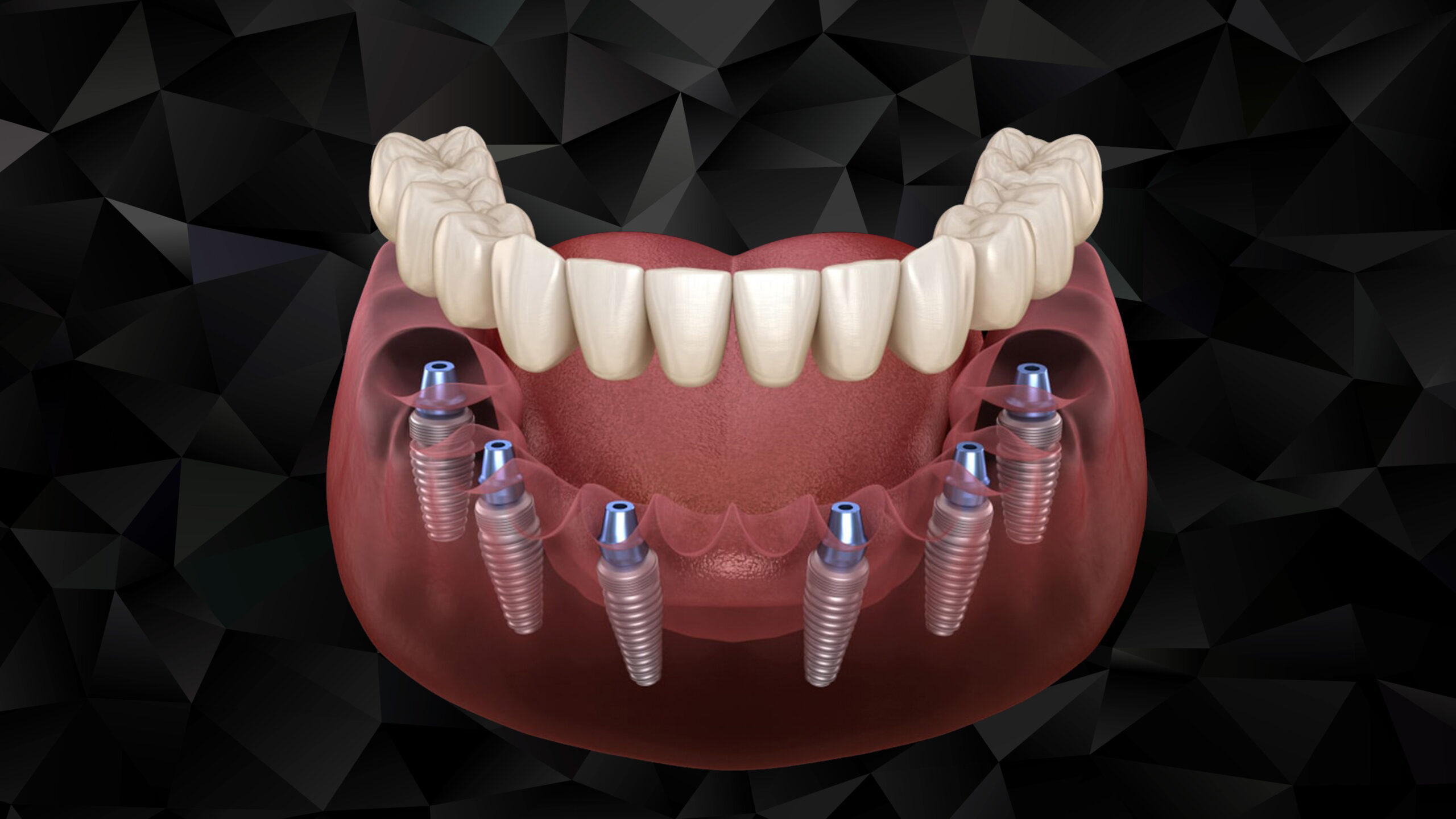 Nha Khoa Quốc Tế Sài Gòn Implant all on 6 phục hình cho hàm bị mất răng hàng loạt