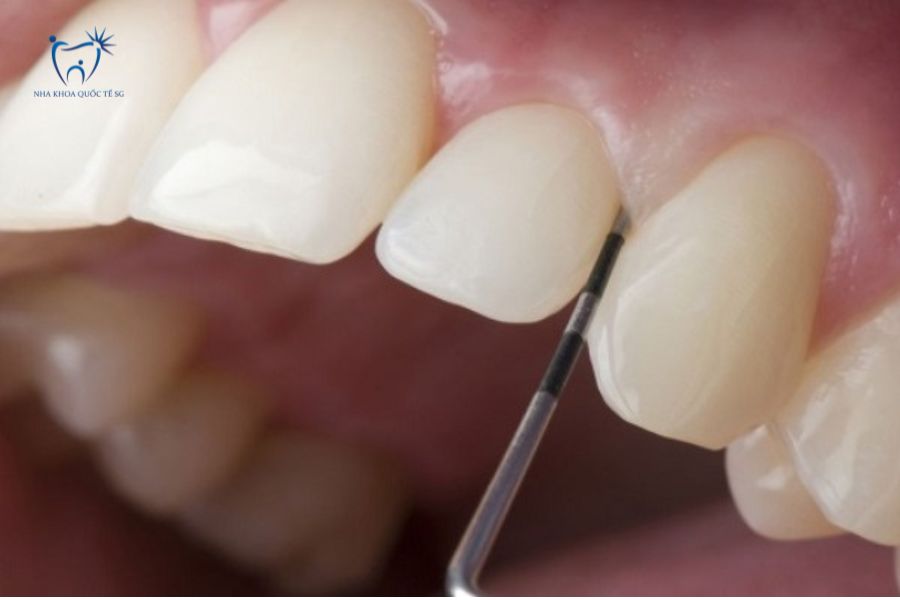 Mài răng trước khi điều trị tủy