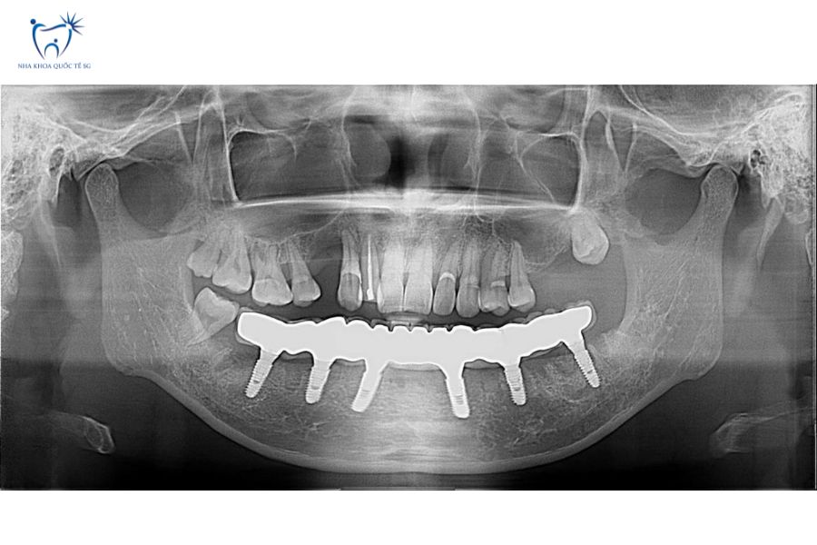 Nha Khoa Quốc Tế Sài Gòn Ảnh chụp X-quang Implant All-in-6 hàm dưới
