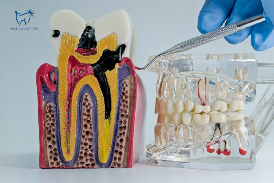 Nha Khoa Quốc Tế Sài Gòn Răng bị sâu đến tủy cần điều trị