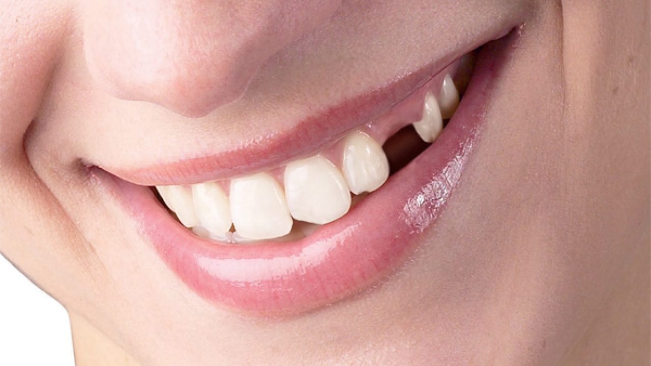 Nha Khoa Quốc Tế Sài Gòn Răng gặp một số bệnh lý ảnh hưởng tính thẩm mỹ