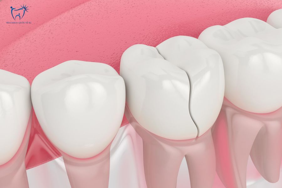 Nha Khoa Quốc Tế Sài Gòn Tình trạng răng sứ bị nứt sau khi niềng răng