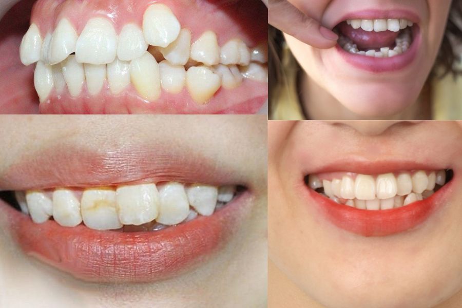 Nha Khoa Quốc Tế Sài Gòn Răng chắc khỏe nhưng vẫn còn tình trạng lệch