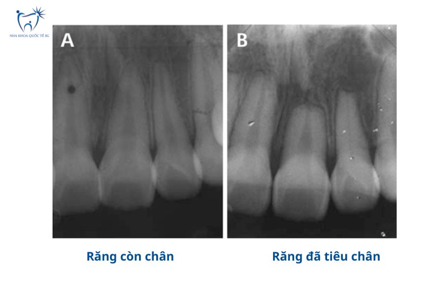 Nha Khoa Quốc Tế Sài Gòn Hình X-quang so sánh răng còn xương chân và răng đã tiêu chân