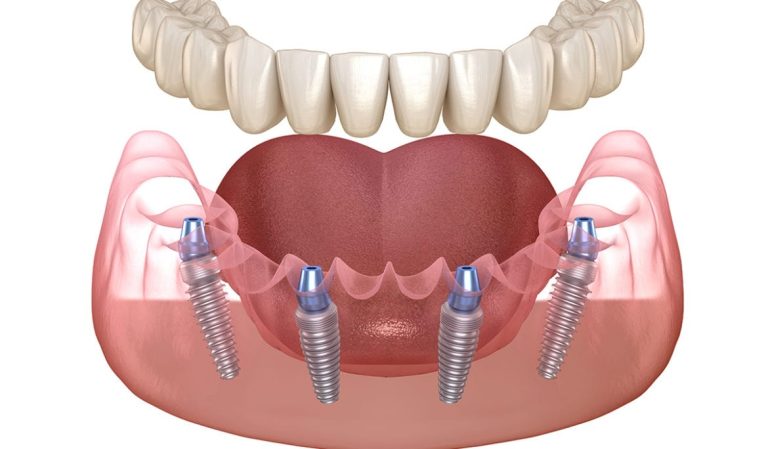 Trồng răng implant all 0n 4 - Giải pháp phục hình răng mất hàng loạt