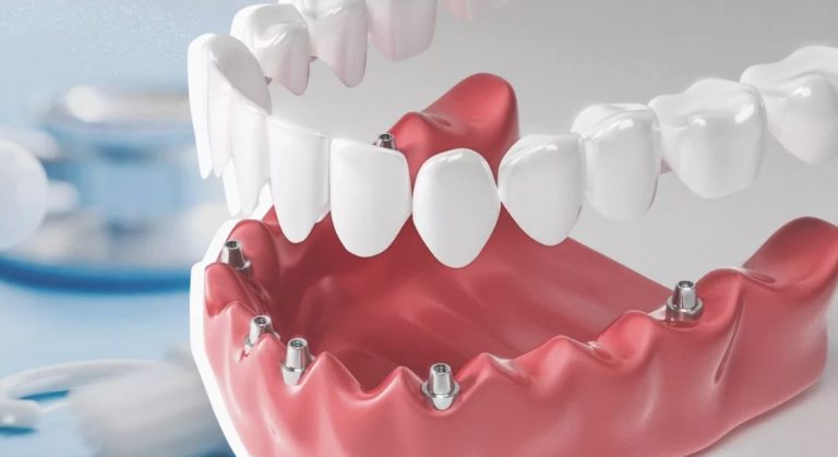 Trồng răng implant đòi hỏi kỹ thuật cao