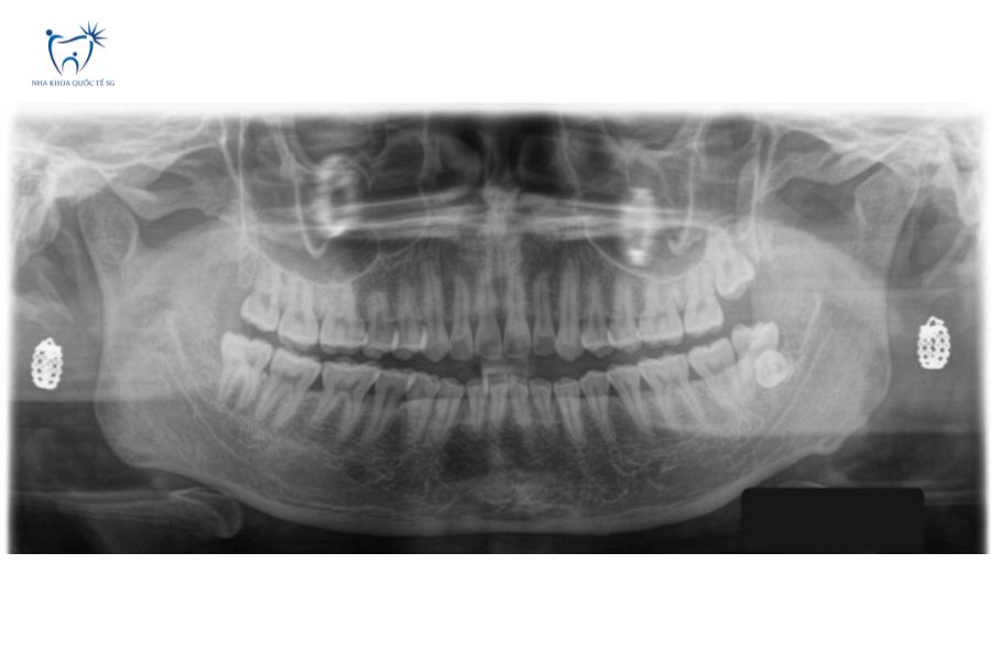 Ảnh X-quang răng khỏe mạnh không nên lấy tủy