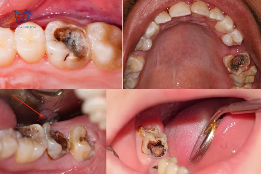 Răng sâu nặng cần điều trị tủy