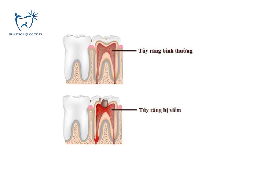So sánh tủy răng bình thường và tủy răng bị viêm