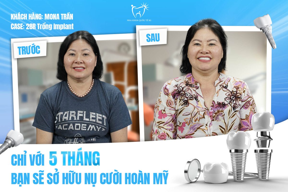 Nha Khoa Quốc Tế Sài Gòn Hình ảnh Feedback của chị Mona Trần khi cắm Implant 28 răng