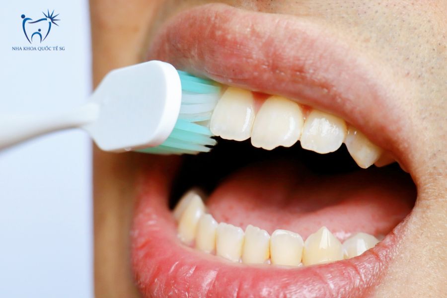 Nha Khoa Quốc Tế Sài Gòn Hướng dẫn đánh răng đúng cách bảo vệ răng sứ