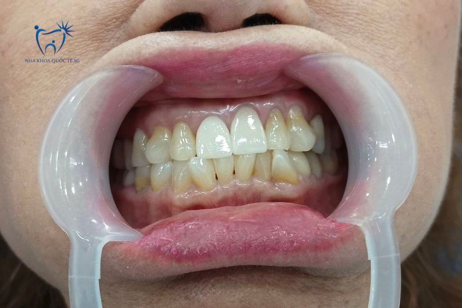 Nha Khoa Quốc Tế Sài Gòn Khách hàng có tình trạng răng sứ xỉn màu