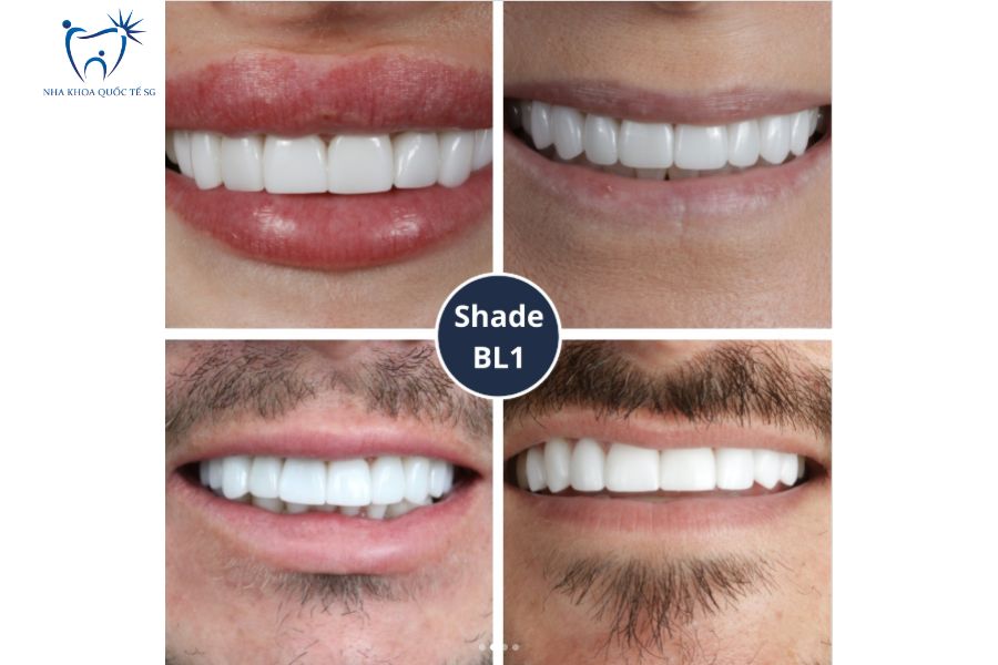 Hình ảnh thực tế khách hàng làm màu răng sứ BL1