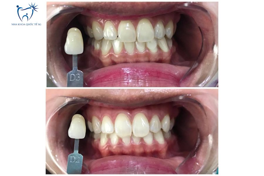 Hình ảnh thực tế khách hàng làm màu răng sứ D2 và D3
