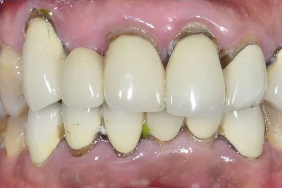 Nha Khoa Quốc Tế Sài Gòn Tình trạng răng sứ xuống màu, nướu có mủ cần thay mới