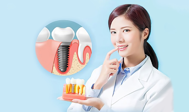Nha Khoa Quốc Tế Sài Gòn trong rang implant nen luu y gi