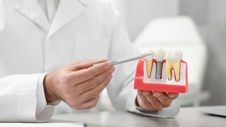 Healing định hình nướu khi trồng implant