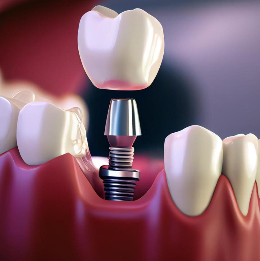 Nha Khoa Quốc Tế Sài Gòn Trồng răng Implant có vĩnh viễn không?