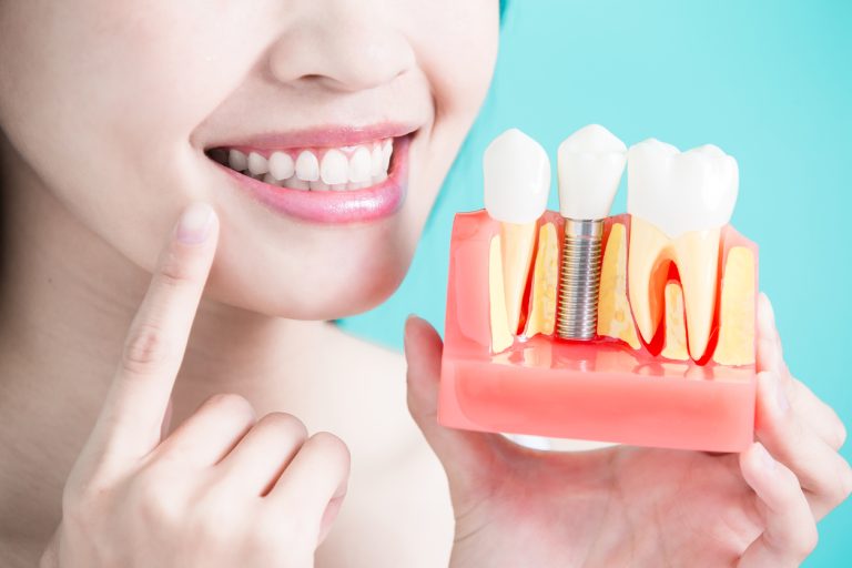 Cấy ghép Implant tại Nha Khoa Quốc Tế SG