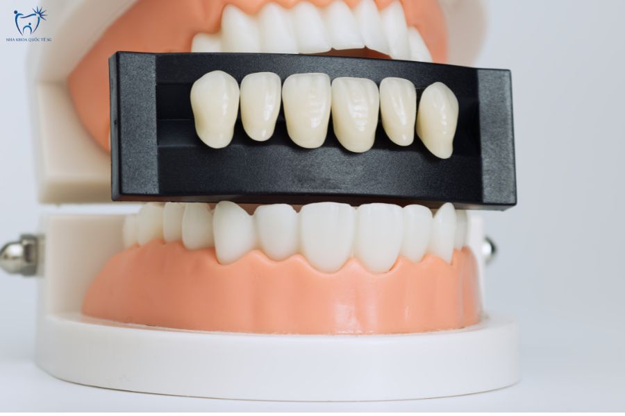 Mô hình dán sứ Veneer thực tế