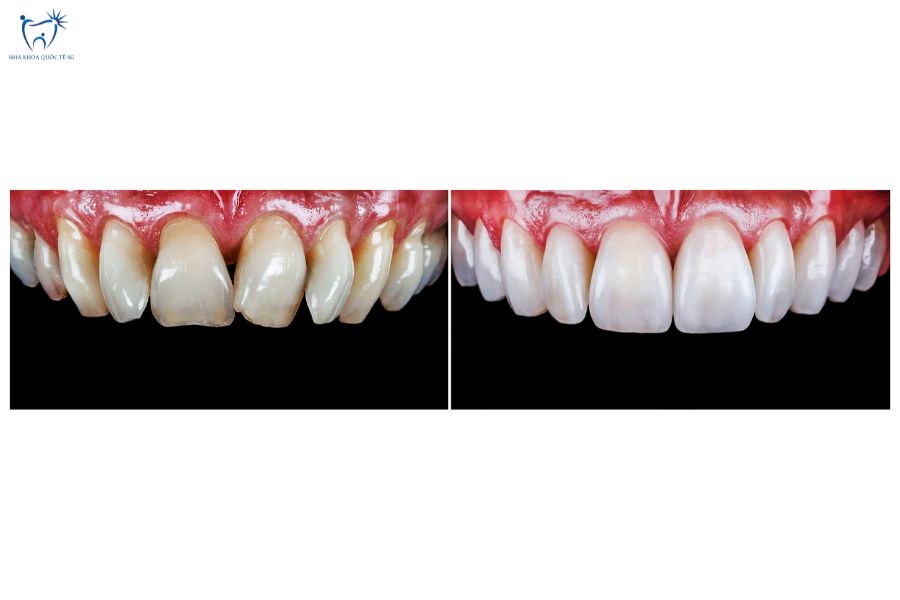 Tình trạng răng trước và sau khi dán sứ Veneer