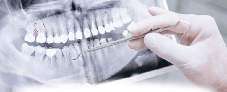 Mòn cổ chân răng là tình trạng răng bị bào mòn