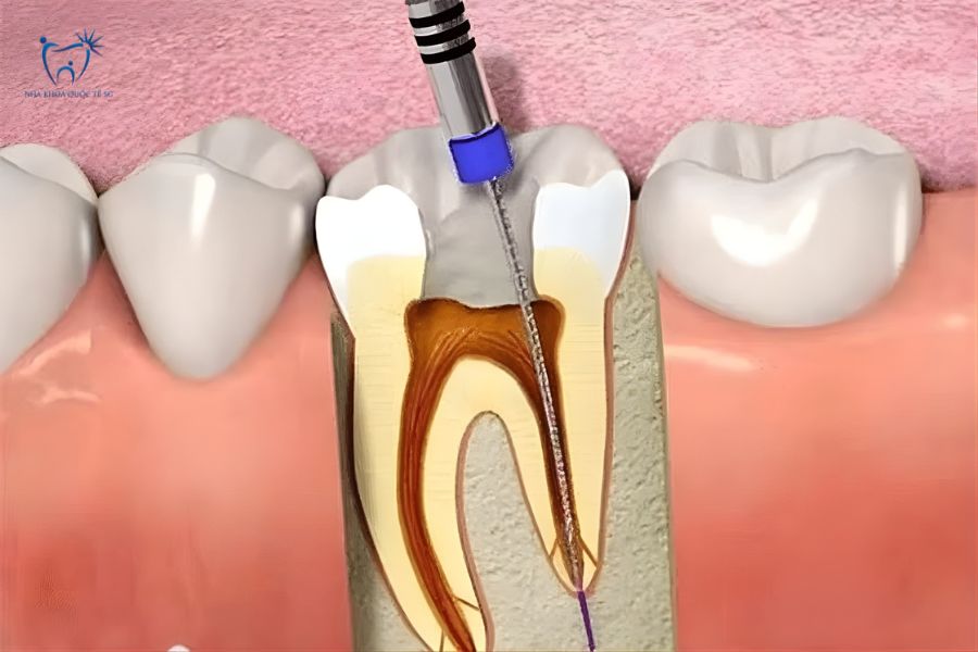 Nha Khoa Quốc Tế Sài Gòn Lấy tủy và điều trị răng bị sâu