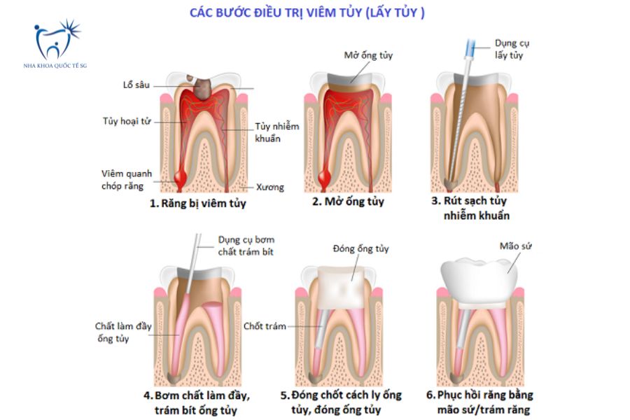 Nha Khoa Quốc Tế Sài Gòn Quy trình điều trị viêm tủy chuẩn y khoa