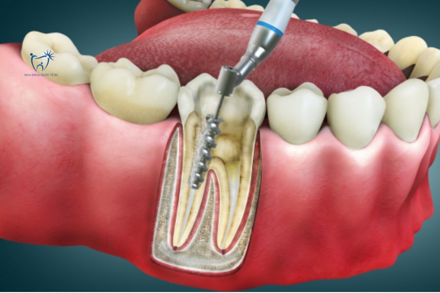 Nha Khoa Quốc Tế Sài Gòn Mũi khoan vào răng và điều trị tủy răng