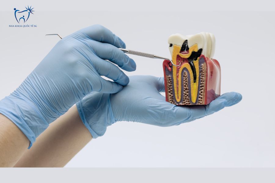 Nha Khoa Quốc Tế Sài Gòn Giá điều trị tủy phụ thuộc vào nhiều yếu tố