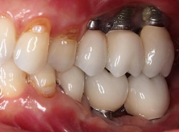 Nha Khoa Quốc Tế Sài Gòn Hối hận trồng Implant giá rẻ và kém chất lượng