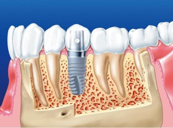 Nha Khoa Quốc Tế Sài Gòn Cấy ghép Implant là phương pháp điều trị tốt nhất khi bị mất răng