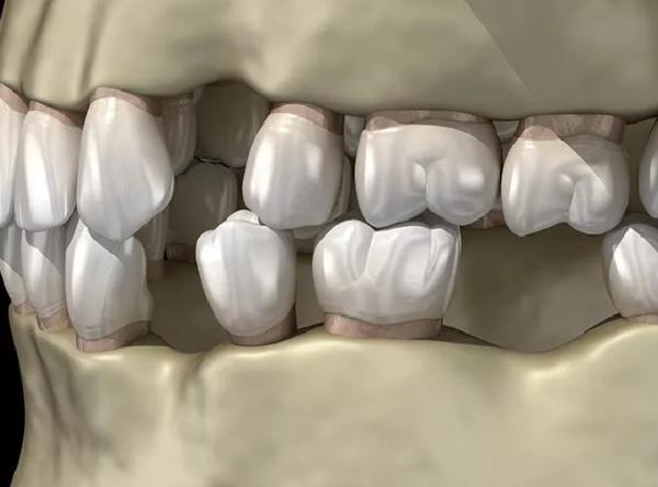 Nha Khoa Quốc Tế Sài Gòn Hậu quả nghiêm trọng khi mất răng không được phục hình sớm
