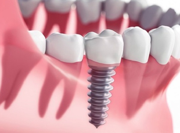 Nha Khoa Quốc Tế Sài Gòn Trụ Implant kém chất lượng sẽ dẫn đến việc viêm nhiễm các vùng đã được cấy ghép