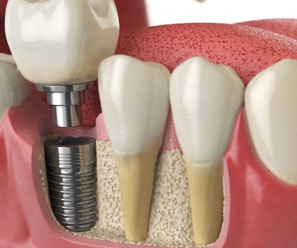 Nha Khoa Quốc Tế Sài Gòn Điều kiện cần thiết để cấy ghép Implant thành công