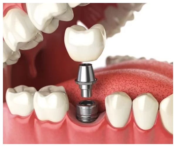 Nha Khoa Quốc Tế Sài Gòn Implant analog được làm sạch và hoàn thiện, sau đó gắn cố định vào mô hình hàm