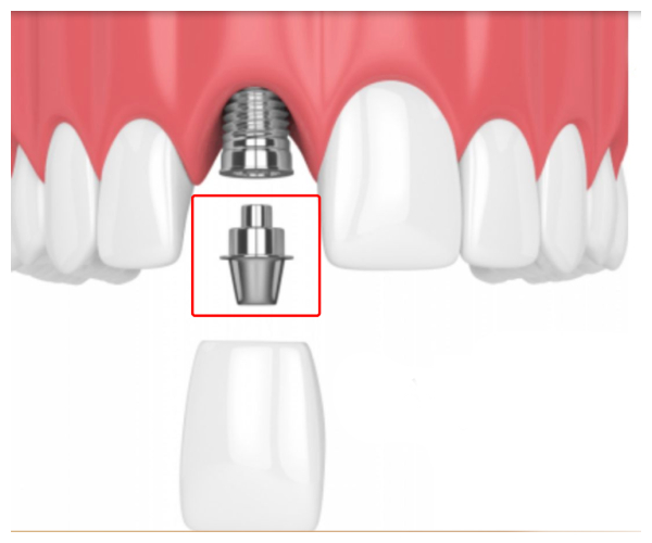 Nha Khoa Quốc Tế Sài Gòn Hình ảnh Abutment gắn trong Implant