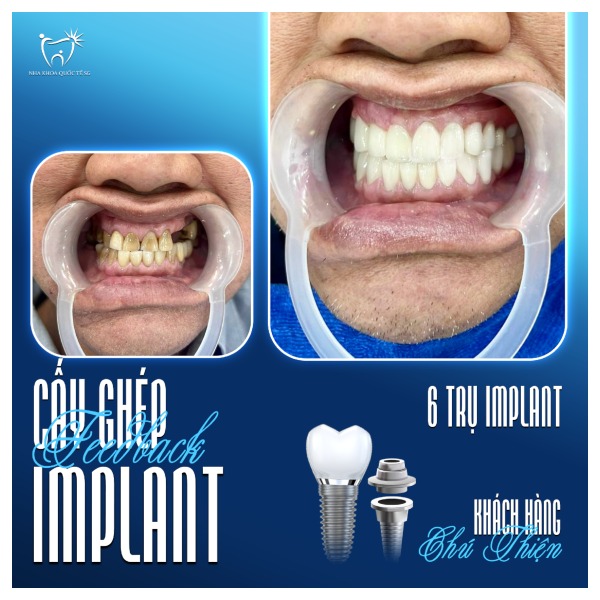 Nha Khoa Quốc Tế Sài Gòn Hình ảnh thực tế răng của khách hàng trước và sau khi cắm trụ Implant