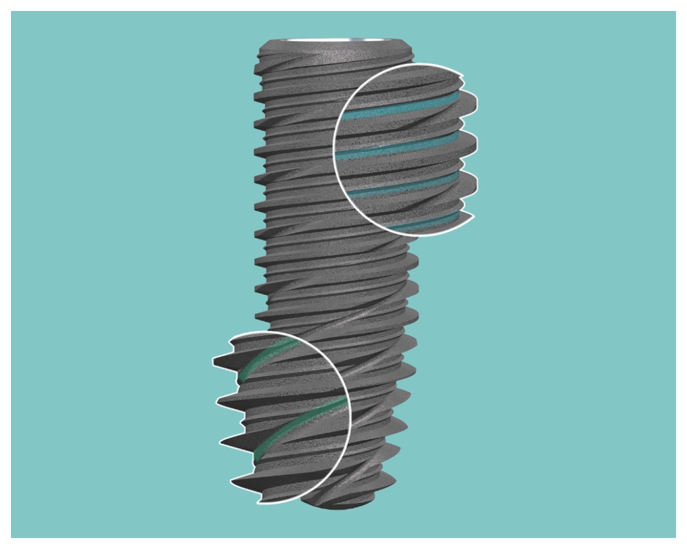 Nha Khoa Quốc Tế Sài Gòn Trụ Implant của Pháp Kontact PL