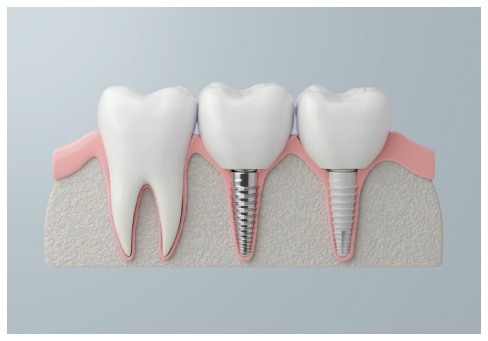 Nha Khoa Quốc Tế Sài Gòn Mỗi loại implant sẽ sở hữu các đặc điểm về cấu tạo, công nghệ,... riêng biệt