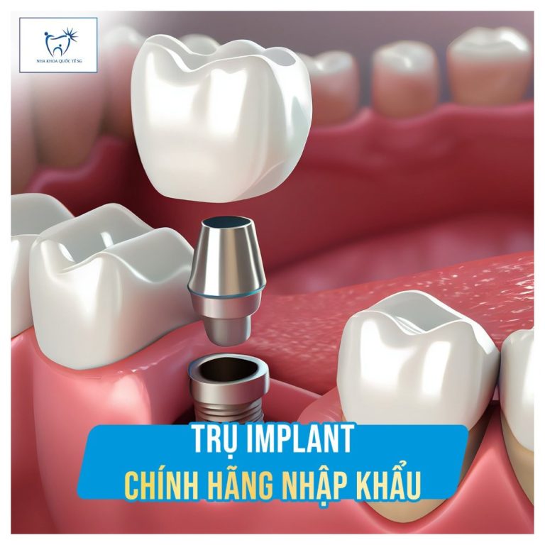 So sánh các loại implant phổ biến nhất hiện nay