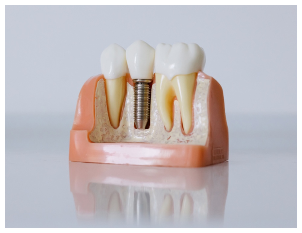 Nha Khoa Quốc Tế Sài Gòn Trụ Implant Hiossen được sản xuất trên dây chuyền hiện đại của hãng HIOSSEN Mỹ