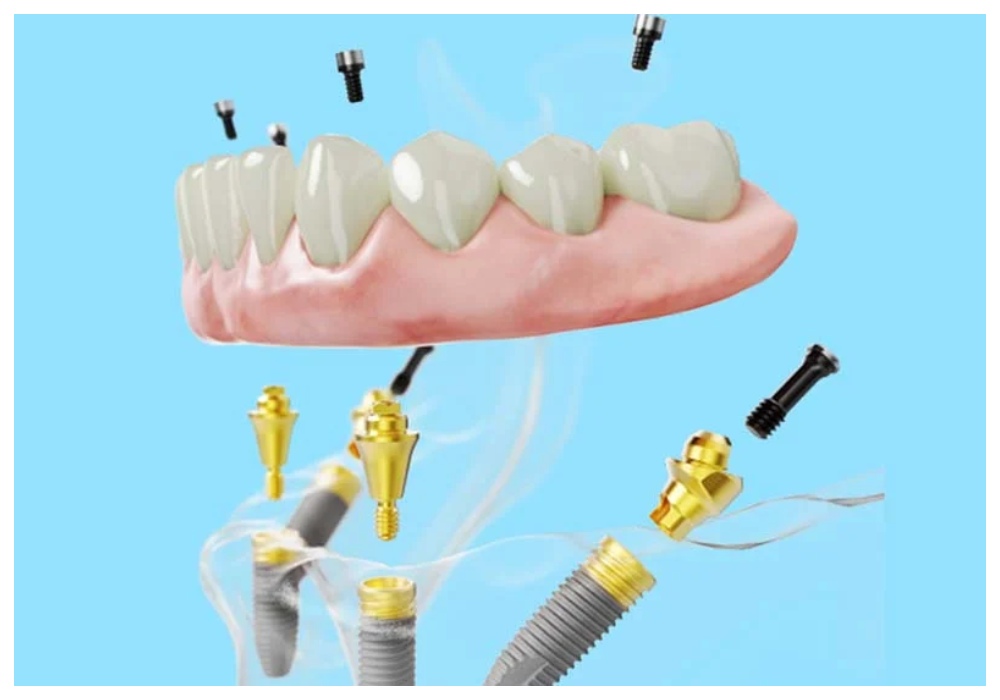 Nha Khoa Quốc Tế Sài Gòn Trụ implant nobel biocare có thời gian tích hợp xương nhanh chóng
