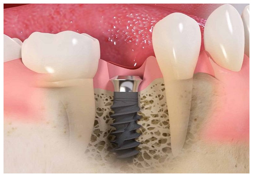 Nha Khoa Quốc Tế Sài Gòn Trụ Implant Straumann với bề mặt xử lý SLA giúp tăng tốc độ lành thương