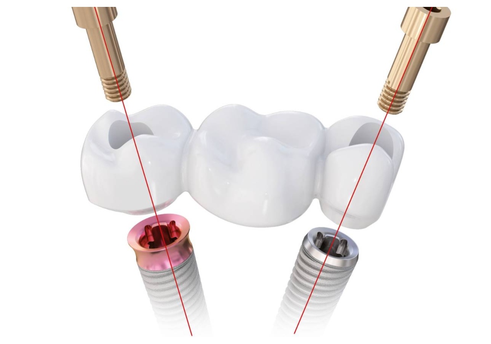 Nha Khoa Quốc Tế Sài Gòn Trụ Implant Thụy Sĩ TRI - Dòng implant với thiết kế nón kép, giúp phân bổ lực đều và tích hợp tối ưu