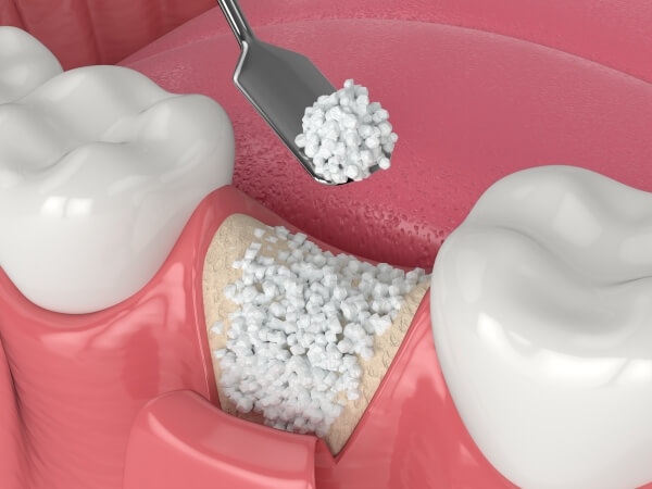 Nha Khoa Quốc Tế Sài Gòn Trồng răng implant bị tiêu xương vẫn được áp dụng nếu thực hiện đúng kỹ thuật