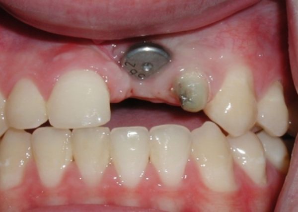 Nha Khoa Quốc Tế Sài Gòn Trồng Implant răng cửa là phương pháp phục hình răng hiện đại hiện nay