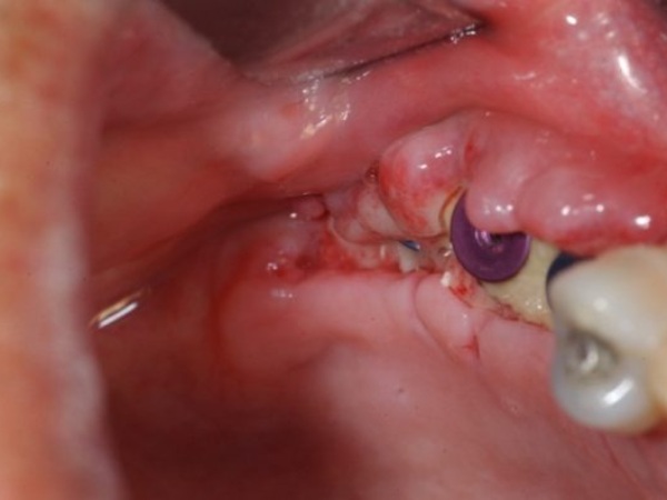 Nha Khoa Quốc Tế Sài Gòn Tình trạng bị viêm quanh Implant gây đào thải trụ