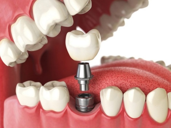 Nha Khoa Quốc Tế Sài Gòn hình ảnh cấy ghép trụ Implant vào răng hàm